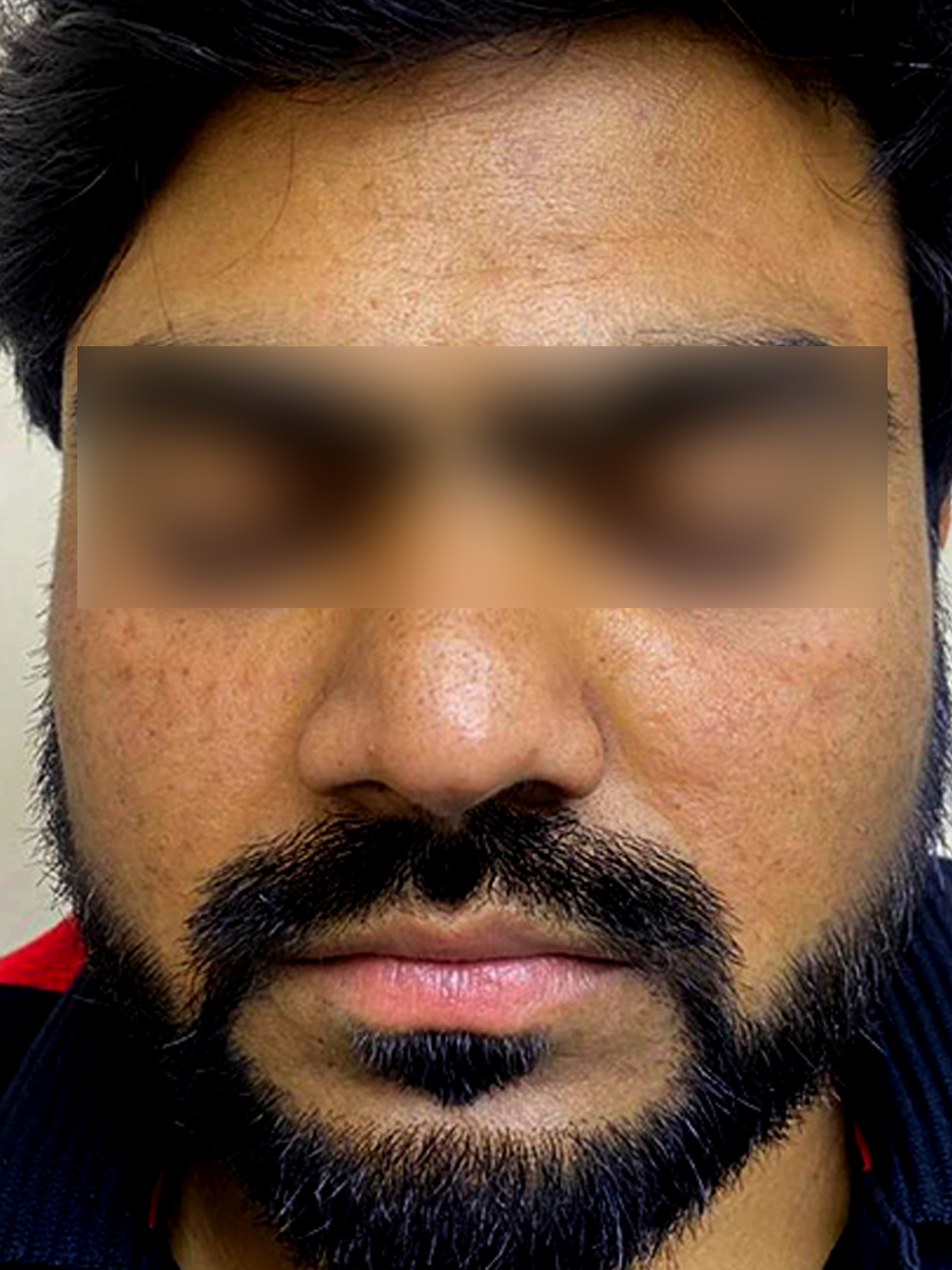 Before treatment